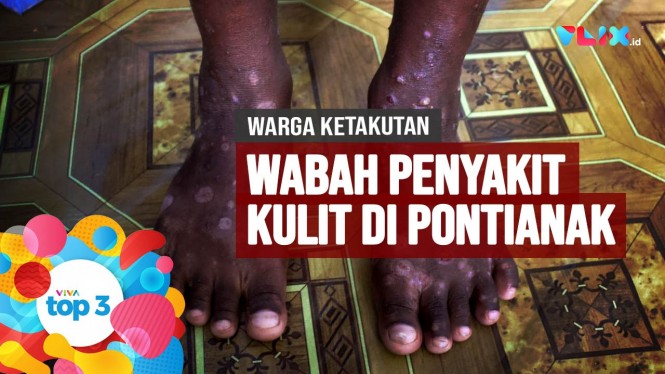 Anies Terancam Risma, Kasus Walikota Bekasi & Penyakit Kulit